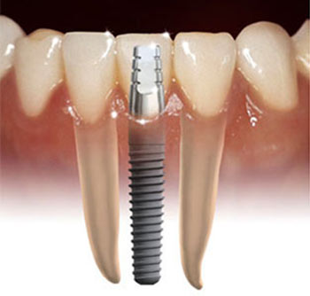 Implantati