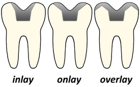 Inlay